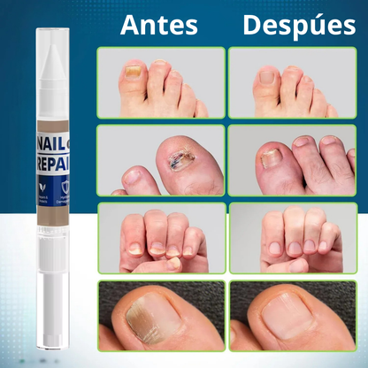Lapiz antifuntico con formula Avanzada - Contra pie de Atleta y HONGOS en uñas