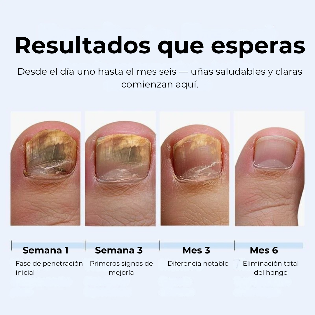 Lapiz antifuntico con formula Avanzada - Contra pie de Atleta y HONGOS en uñas