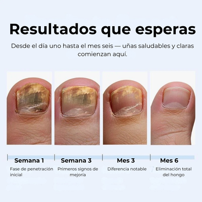 Lapiz antifuntico con formula Avanzada - Contra pie de Atleta y HONGOS en uñas