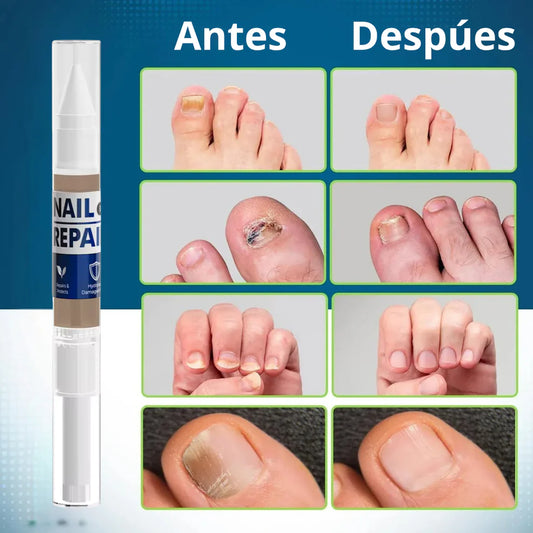 Lapiz antifuntico con formula Avanzada - Contra pie de Atleta y HONGOS en uñas